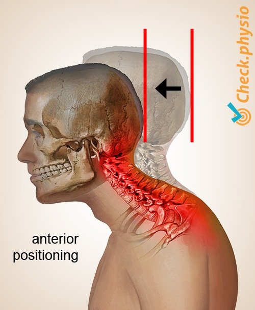 Cervical (Neck) Pain 2